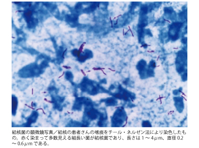 結核菌の顕微鏡写真／結核の患者さんの喀痰をチール・ネルゼン法により染色したもの。赤く染まって多数見える細長い菌が結核菌であり、長さは1～4μm、直径0.2～0.6μmである。